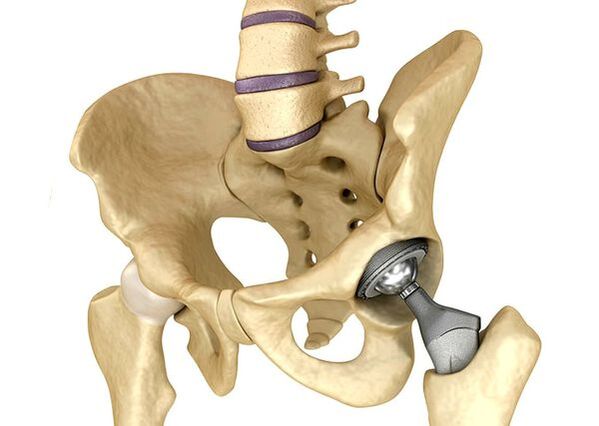 Endoprotetics of the hip joint
