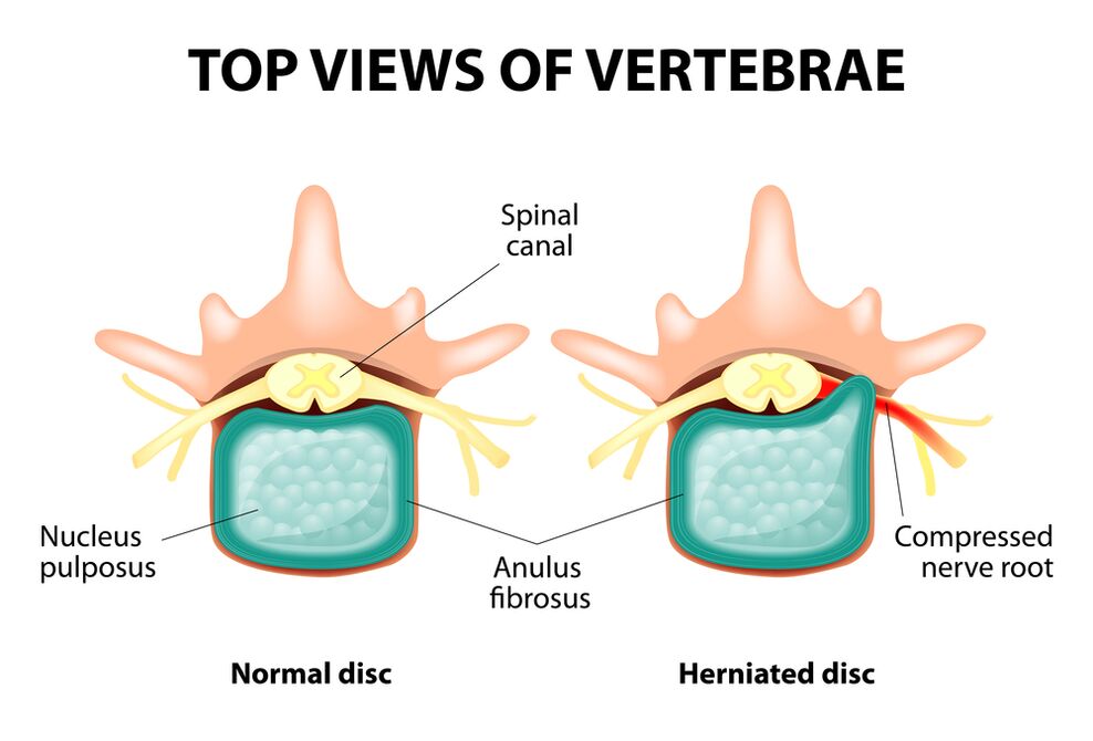 Healthy Intervertebral Disk and Brok
