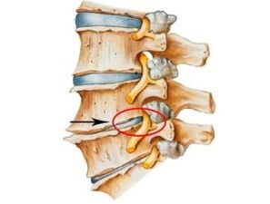 Signs and symptoms of osteocondrosis