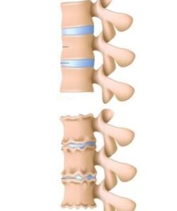 The causes of osteocondrosis