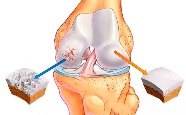 A normal knee joint (right) and one affected by osteoarthritis (left)