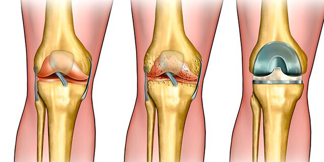 In the third stage of osteoarthritis, knee replacement is required